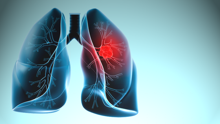 Akciğer hastalarına yeni bir umut