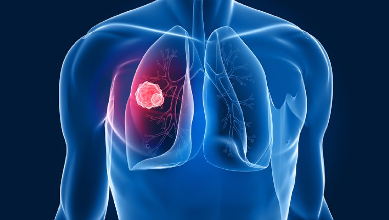 Akciğer kanserinin belirtileri nelerdir