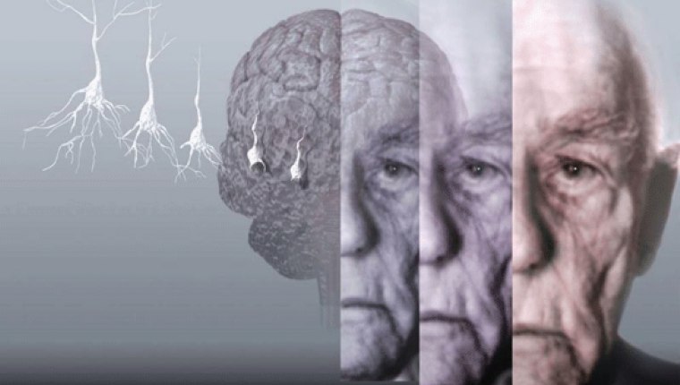 Alzheimer hastalığının nedenleri, belirtileri ve tedavisi