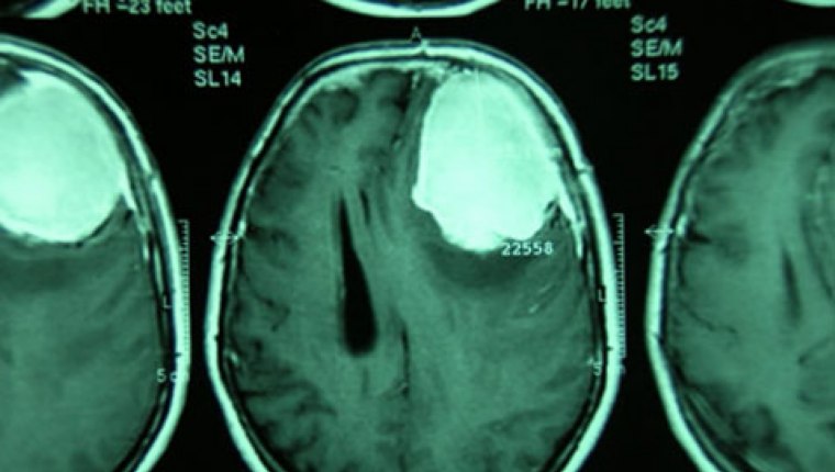 Beyinde tümör oluşumunu engelleyecek aşı