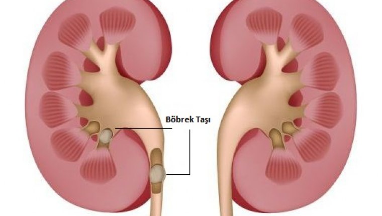 Böbrek taşı hastalarına uyarı ve öneriler