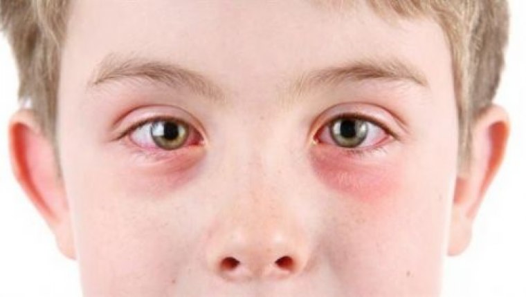 Çocuğunuzun gözü sık sık şişiyor mu?