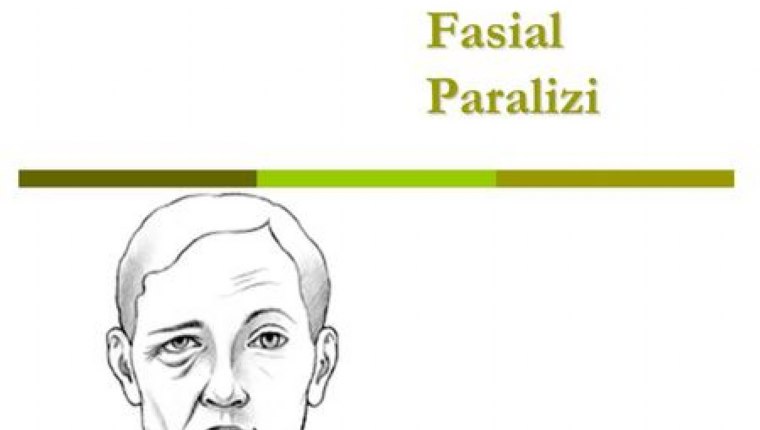 FASİAL PARALİZİ