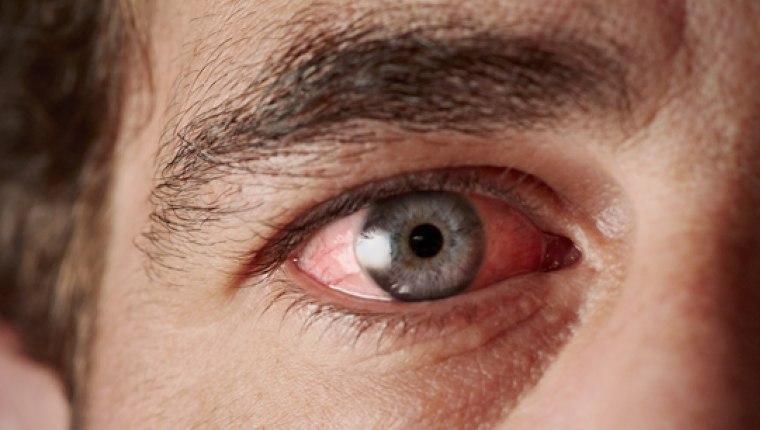 Kuru göz hastalığının nedenleri ve tedavisi